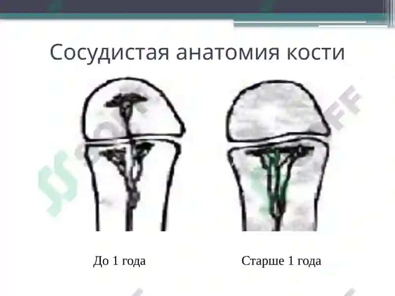 Острый гематогенный остеомиелит у детей 4