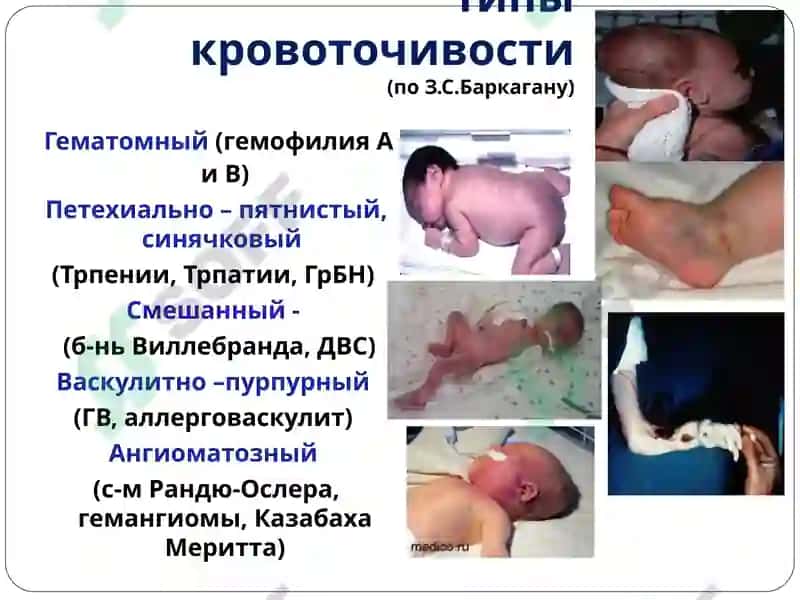 Нарушения в системе гемостаза у детей раннего возраста 4