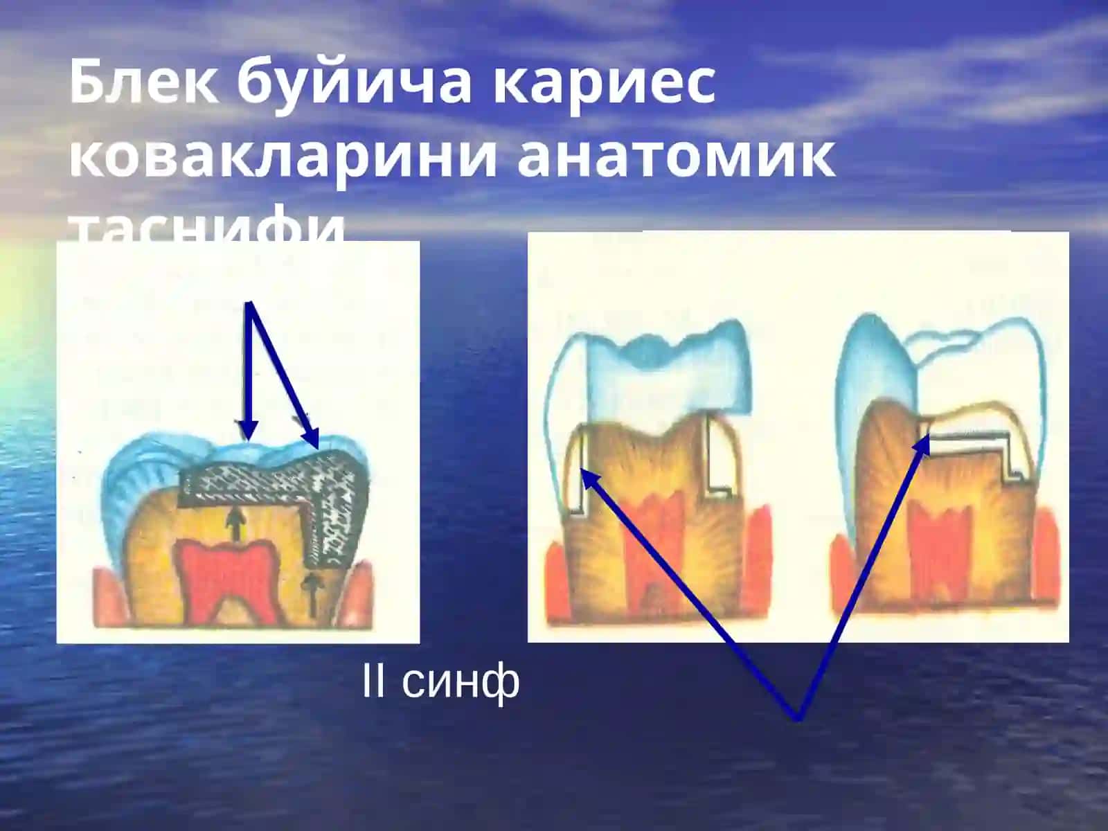 Кариесковакни чархлаш босқичлари ва ускублари 4