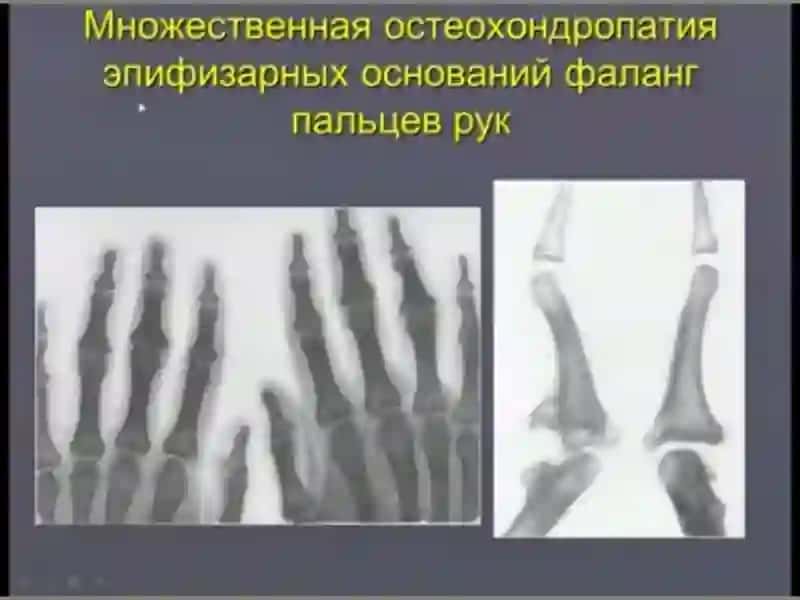 OSTEOXONDROPATIYA 4