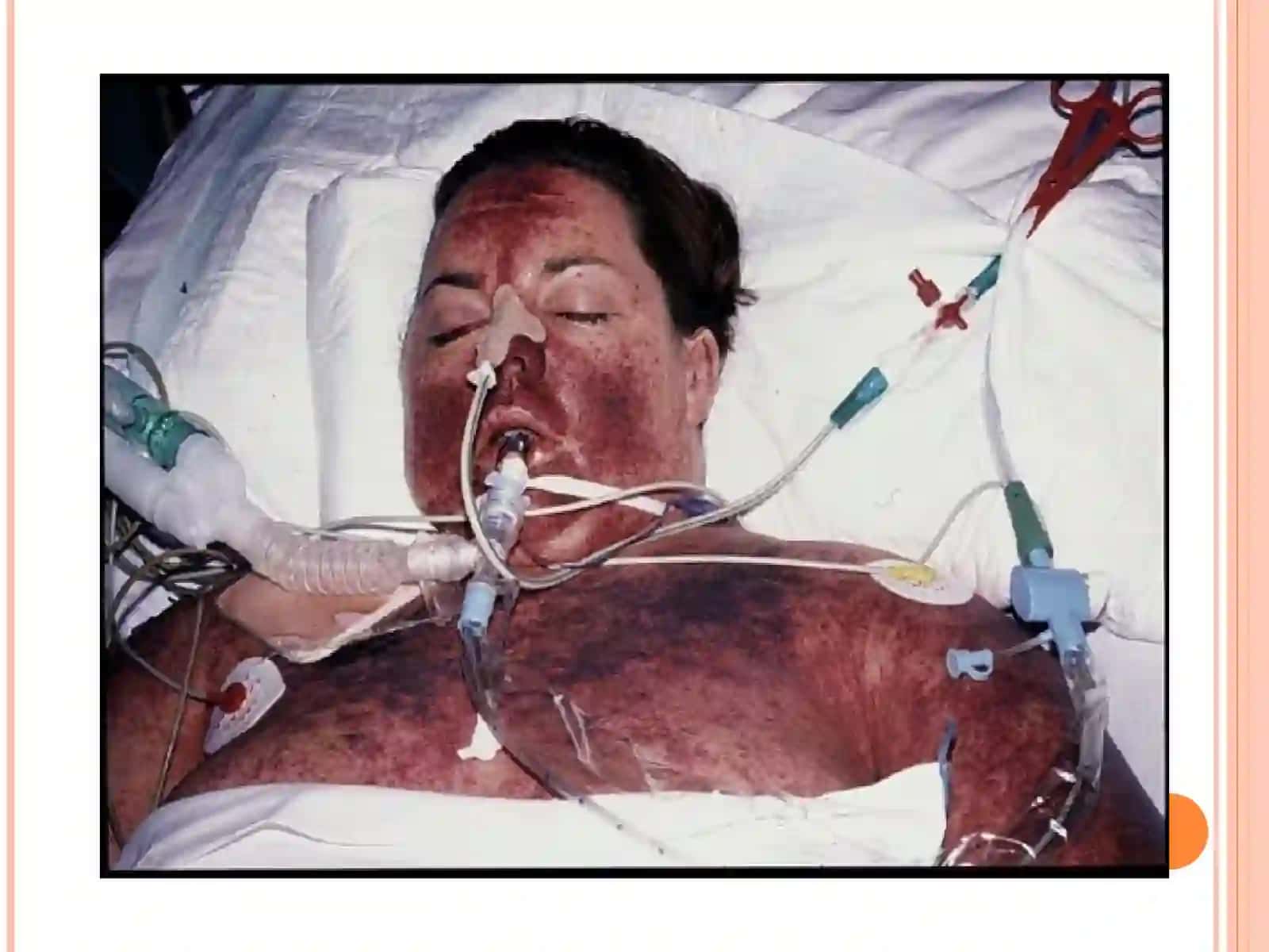 DIC-DISSEMINATED INTRAVASCULAR COAGULATION 4