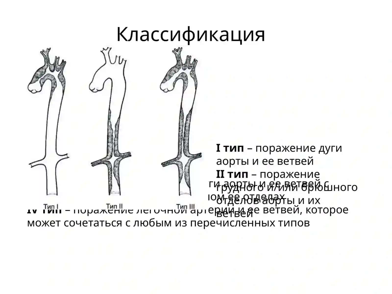 БолезньТакаясу(неспецифическийаортоартериит, синдромдугиаорты) 4