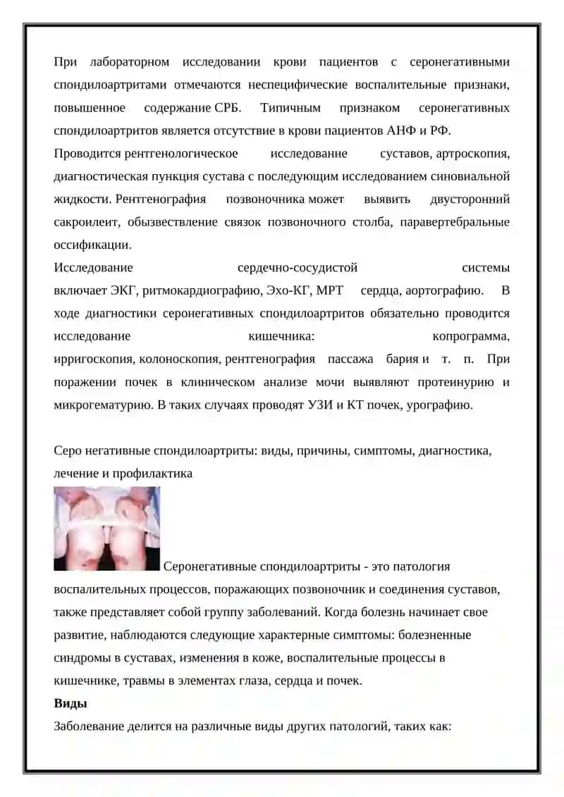 Серонегативный спондилоартрит (реактивный артрит, болезнь Бехтерева, псориатический артрит) Диагностические критерии 4