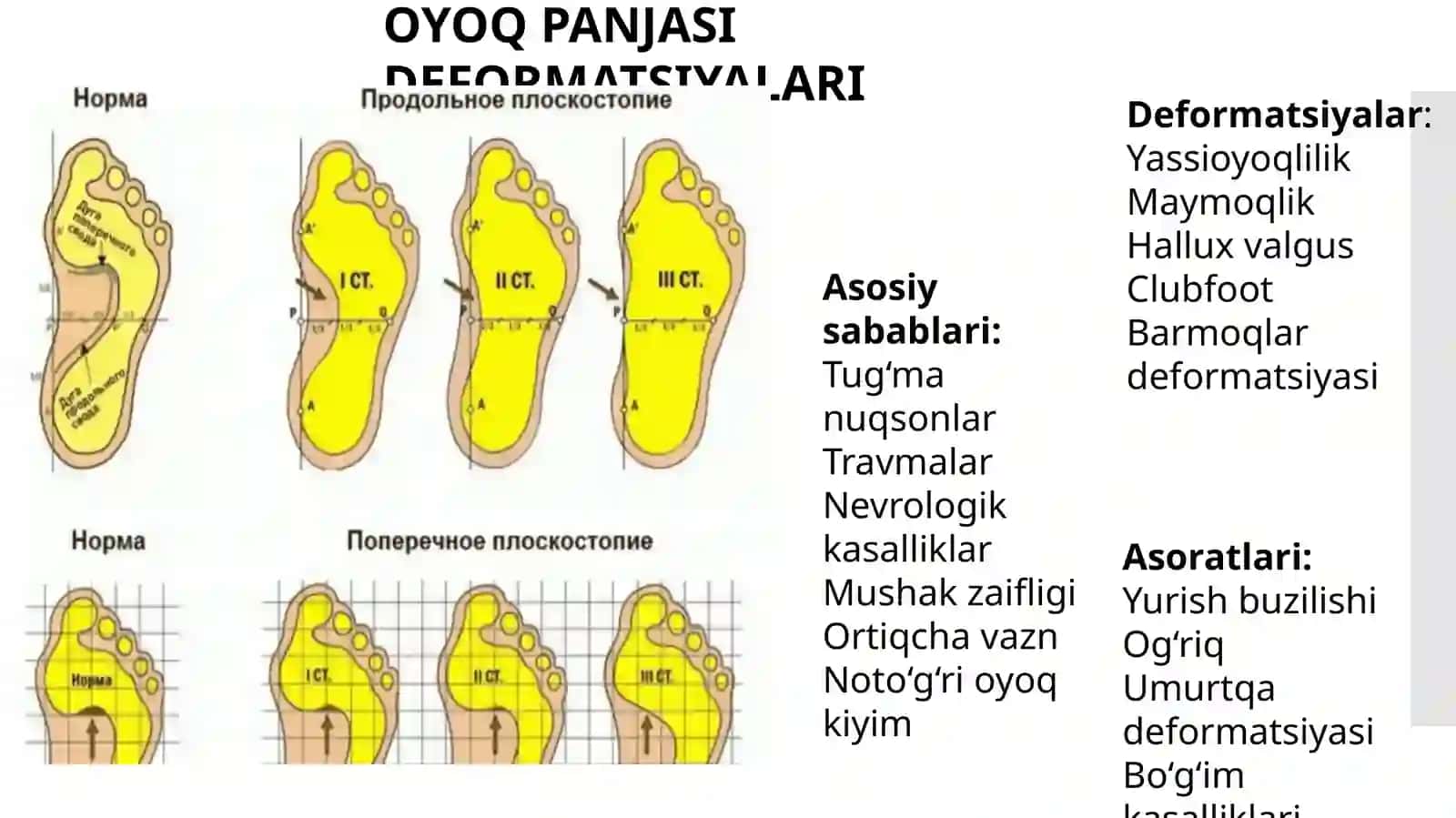 oyoq panjasi deformatsiyalari . maymoqlik va yassioyoqlik 4