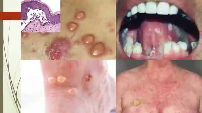 Dermatozlar va po'rsildi kasalliklari 4