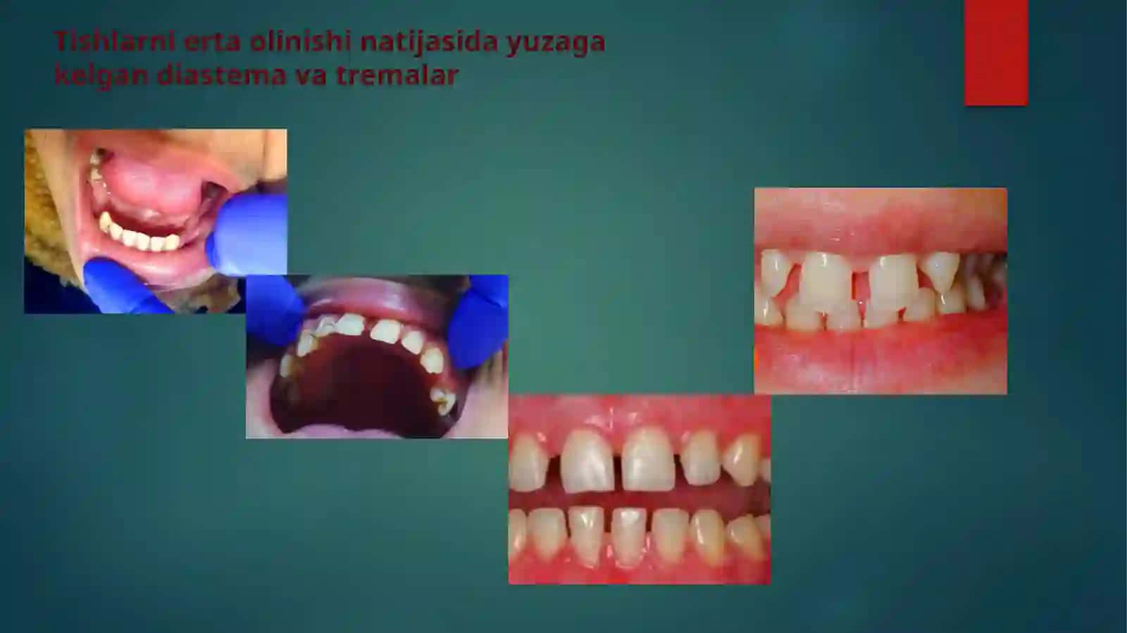 Tishlarni erta olinishi natijasida yuzaga kelishi mumkin boʻlgan asoratlar 4