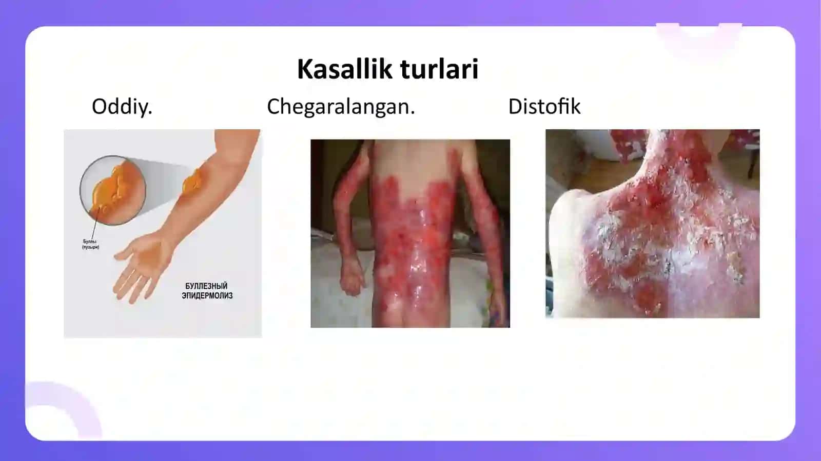 Bullyozepidermoliz, Xeyli-Xeylikasalligi 4