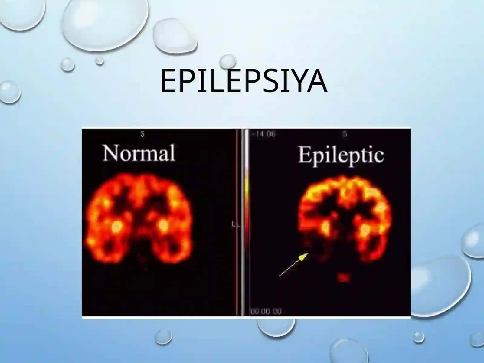 Epilepsiya kasaligining kelib chiqish sabablari va asoratlari 4