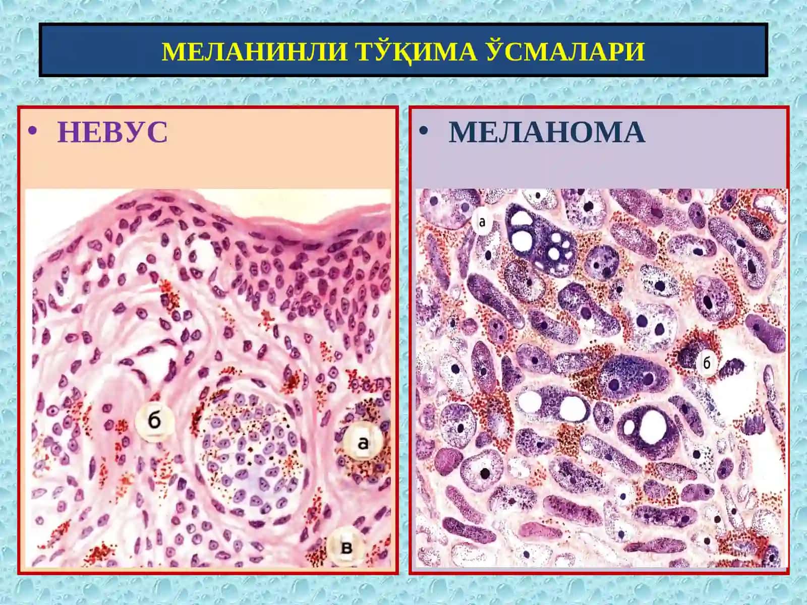 Меланинли ва нерв тўқима ўсмалари 4