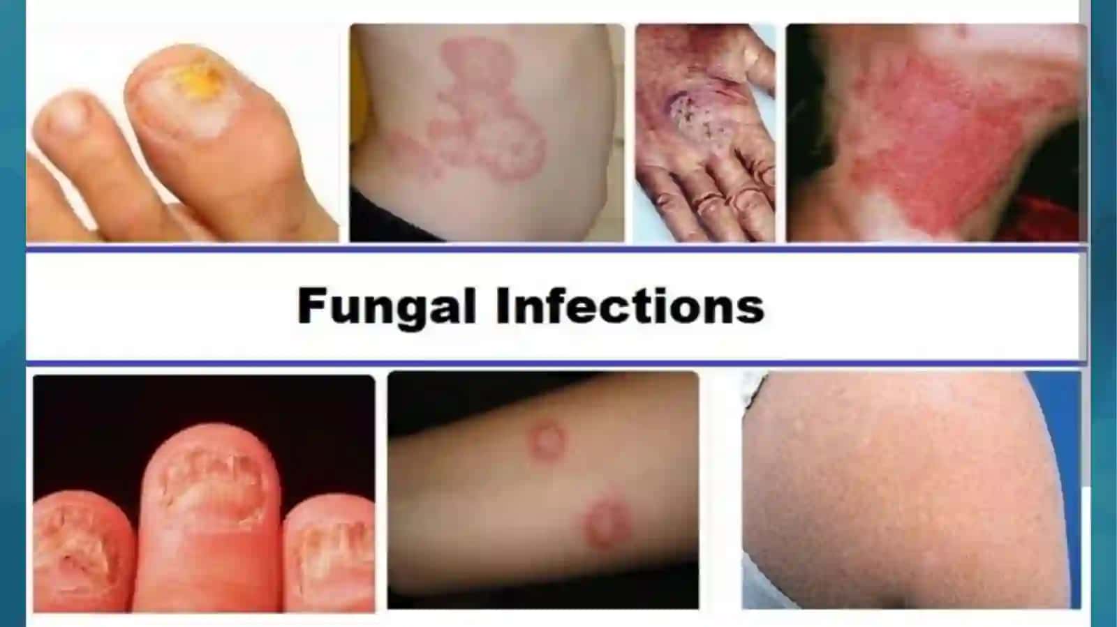 Zamburug' infeksiyalari.Parazitar infeksiyalar 4