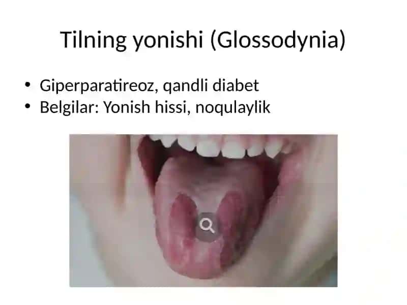 Endokrin kasalliklarda og‘iz bo‘shlig‘ida kuzatiladigan o‘zgarishlar va dispanserizatsiya 4