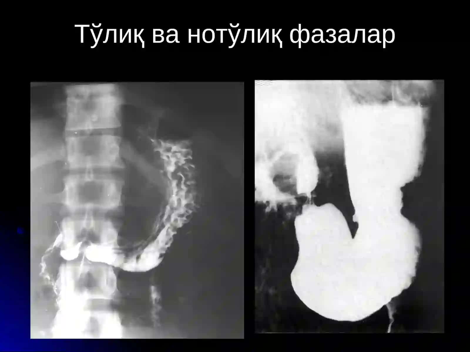 ОШКОЗОН-ИЧАК КАСАЛЛИКЛАРИ НУР ТАШХИСИ АФЗАЛЛИГИ 4
