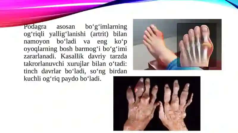 Podagra kasalligi 4