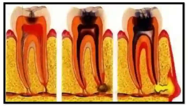 O‘tkir va surunkali periodontitlarni ambulator sharoitda davolash. O‘tkir periodontit shakllarida 4