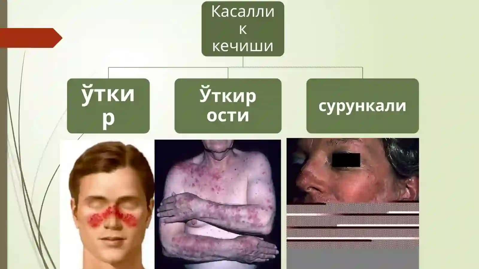 Кизил югурик (erythematosus)бириктирувчи тўқима касалликлари 4