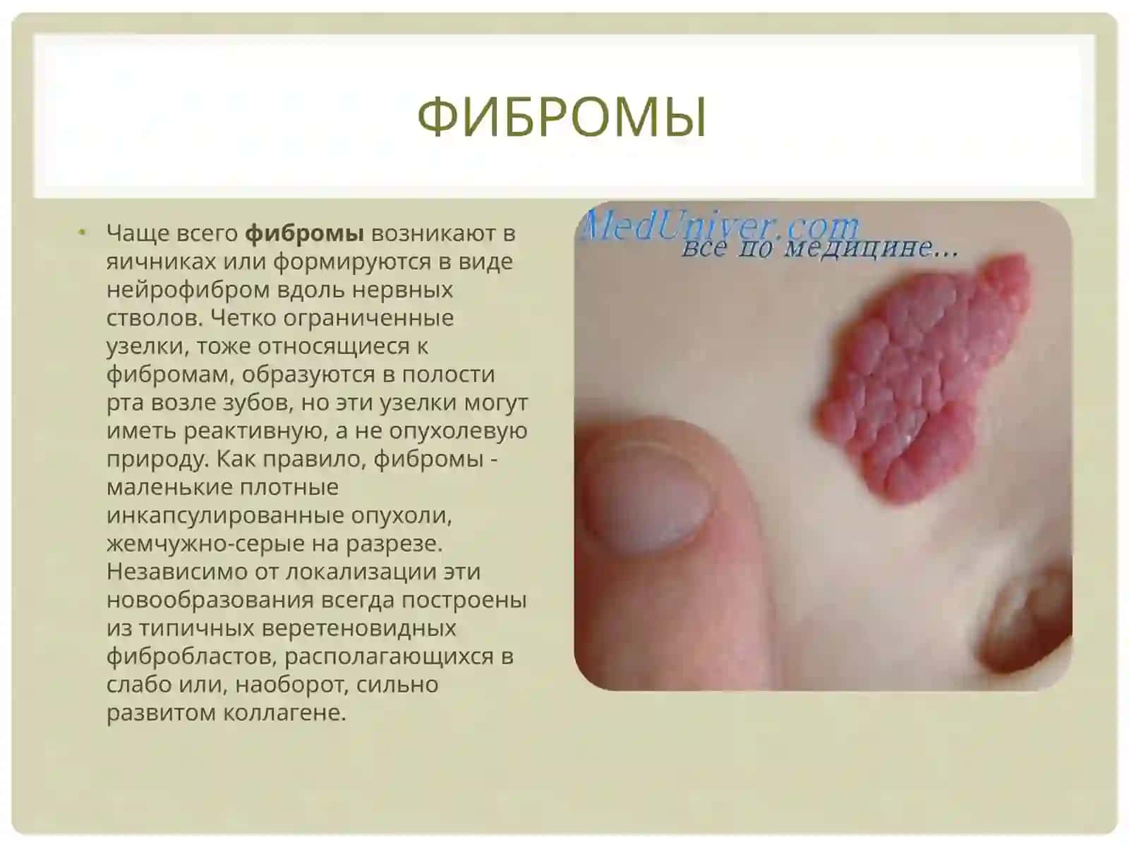 Мезенхимальные опухоли 4