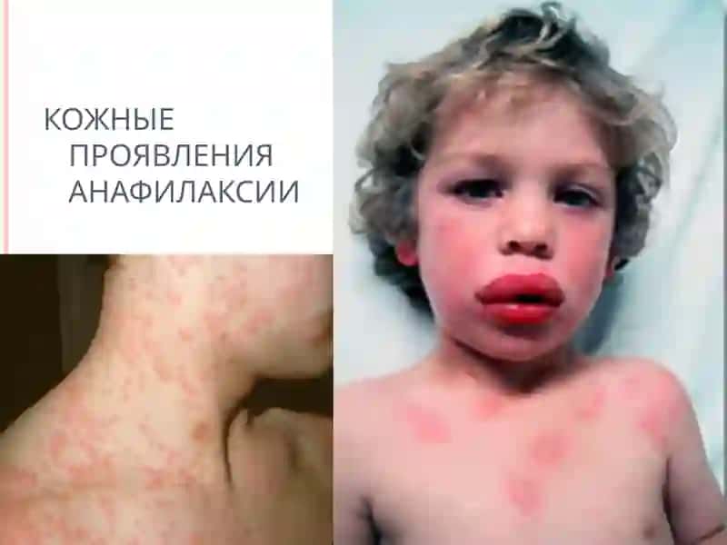 АНАФИЛАКТИЧЕСКИЙ ШОК 4