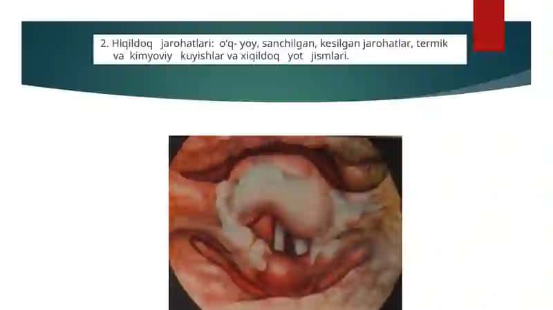 Hiqildoqning oʻtkir va surunkali kasalliklari 4