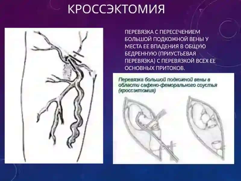 современнаясклеротерапия 4