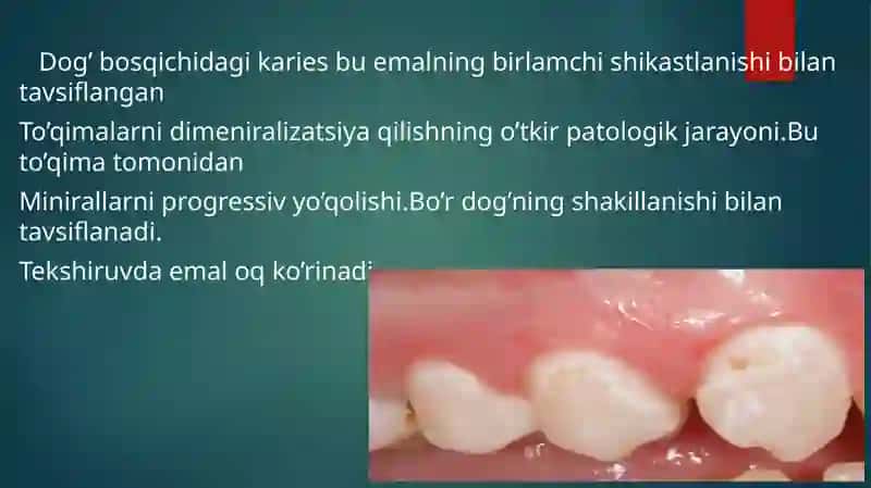 Dog’bosqichidagikariesni davolash va oldini olish 4