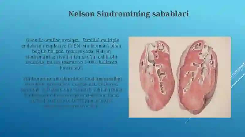 Nelson Sindromi: Ta'rif va Etiologiya 4
