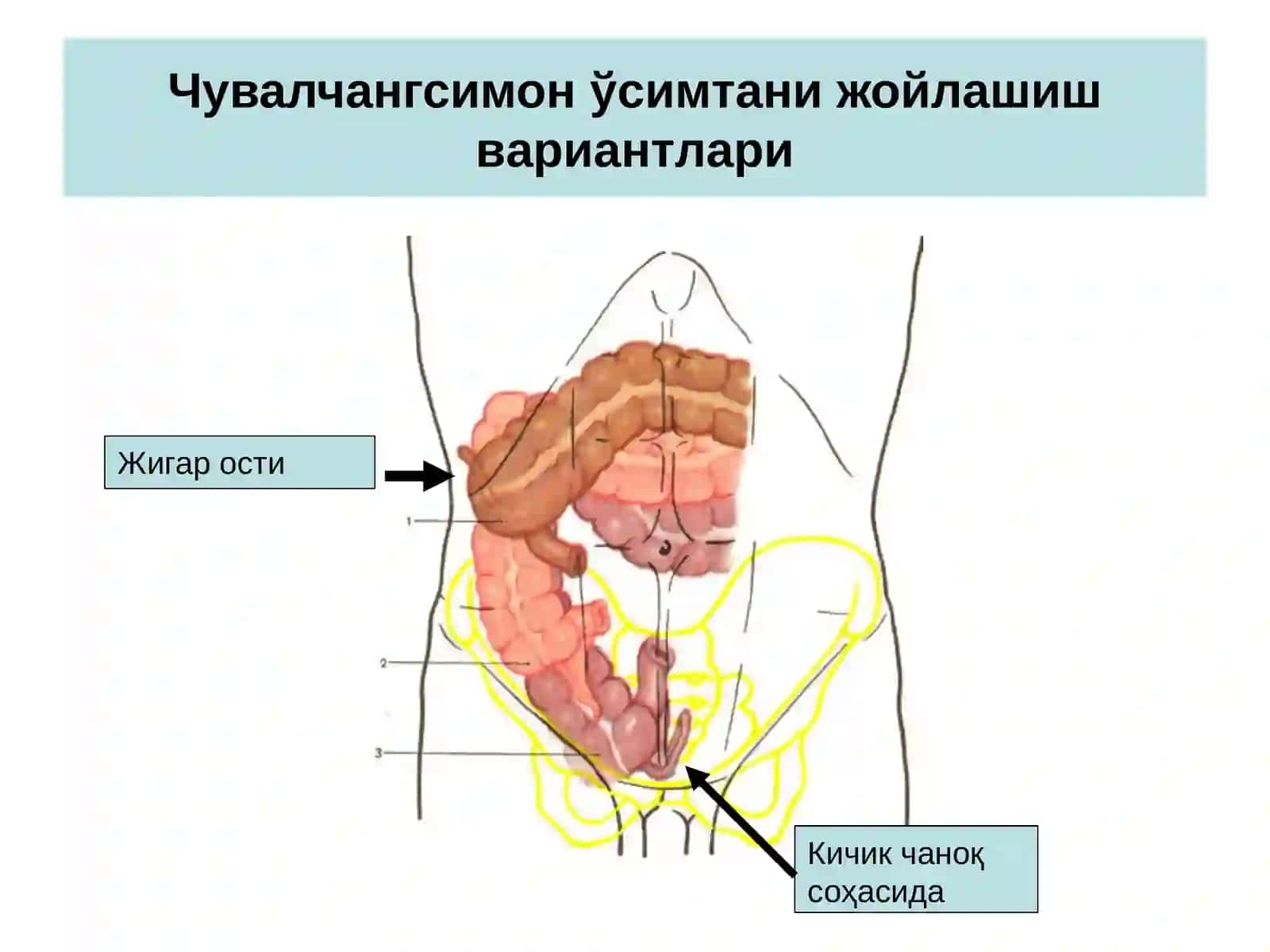 Ўткир аппендицит-чувалчангсимон ўсимтанинг ўткири носпецифик яллиғланиши 4