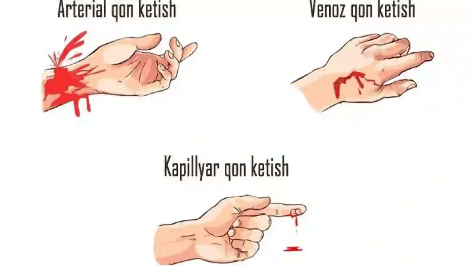 Qo‘l va oyoq qon tomirlarda bajariladigan operatsiyalar turlari va texnikasi 4