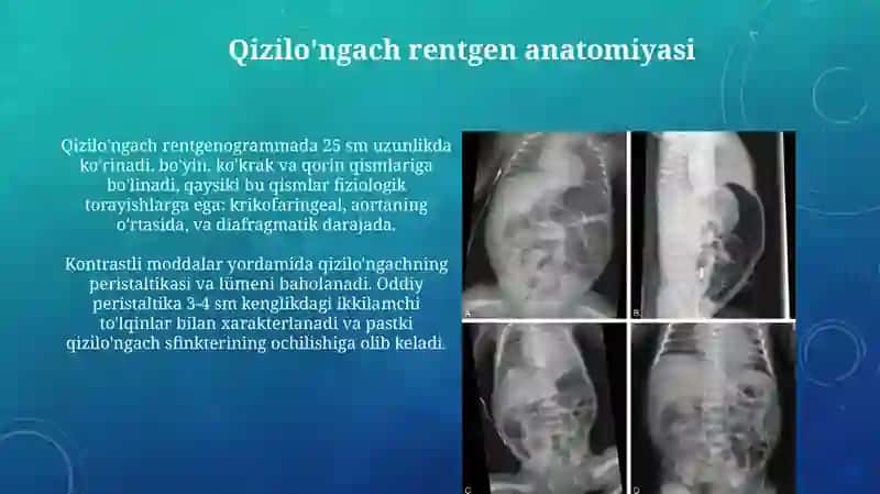 Hazm a'zolarining rentgenanatomiyasi va rivojlanish nuqsonlari 4