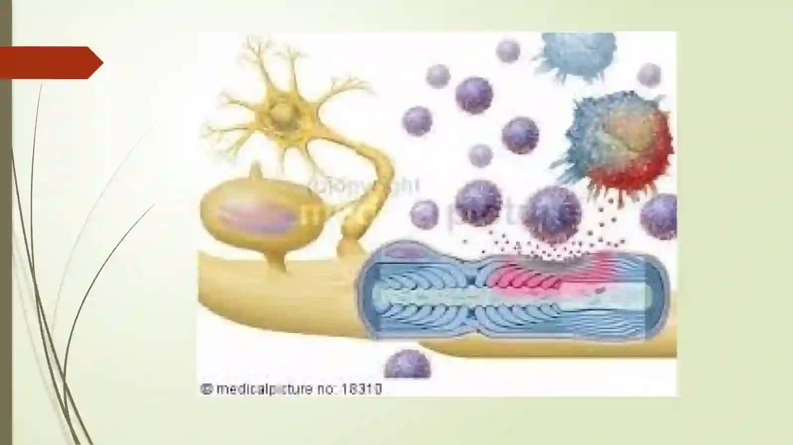 Asabtizimidemiyelinizatsiyalikasalliklari. (tarqoqskleroz,alsgemer, Harrington, parkinsonism,xorea) 4