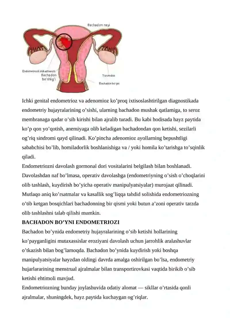 ENDOMETRIOZ: SABABLARI, ALOMATLARI, TASNIFI, DAVOLASH, OLDINI OLISH, ASORATLARI 4