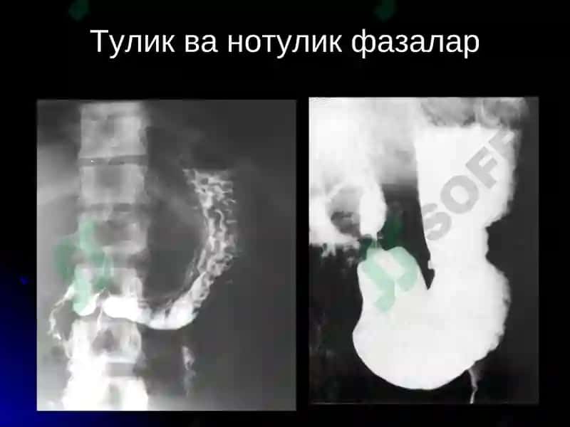 Ошкозон-ичак касалликларининг нур ташхиси 5