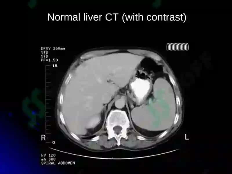 IMAGING OF LIVER DISEASES 5