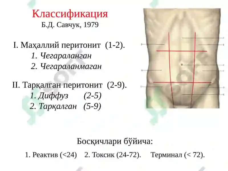 Ўткир перитонит 5