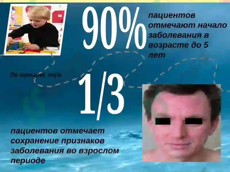Atopik dermatit 5
