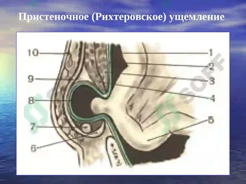 Осложнения грыж живота 5