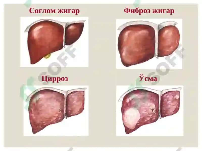 Жигар, ўт йўллари ва меъда ости безини ривожланиш нуқсонлари ва аномалиялари 5