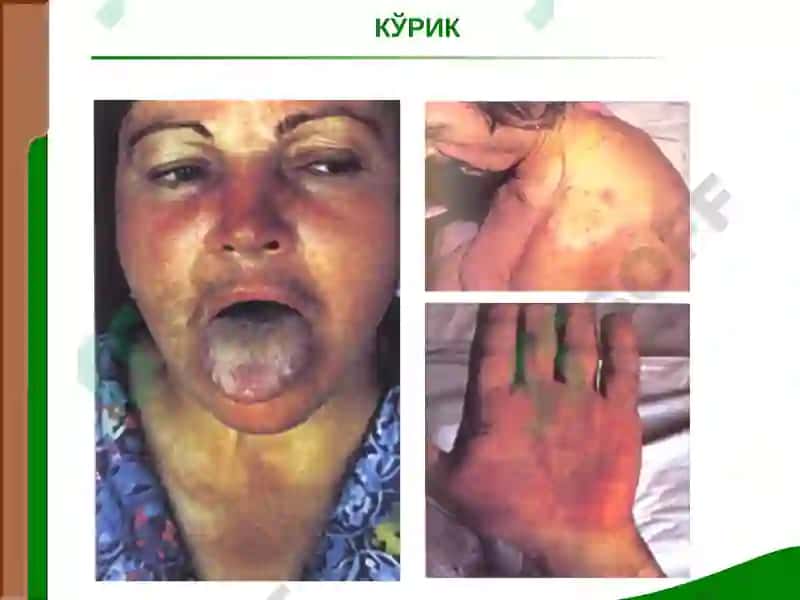Жигар ва ўт йуллари касалликлари билан касалланган беморларни текшириш 5