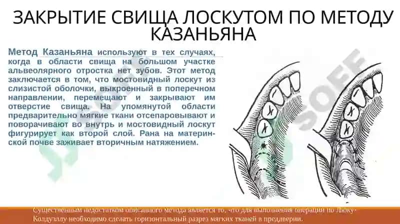 СПОСОБЫ ХИРУРГИЧЕСКОГО ЗАКРЫТИЯ СООБЩЕНИЯ МЕЖДУ ГАЙМОРОВОЙ ПАЗУХОЙ И АЛЬВЕОЛОЙ 5