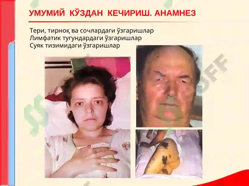 КОН ТИЗИМИ КАСАЛЛИКЛАРИ БИЛАН КАСАЛЛАНГАН БЕМОРЛАРНИ ТЕКШИРИШ 5