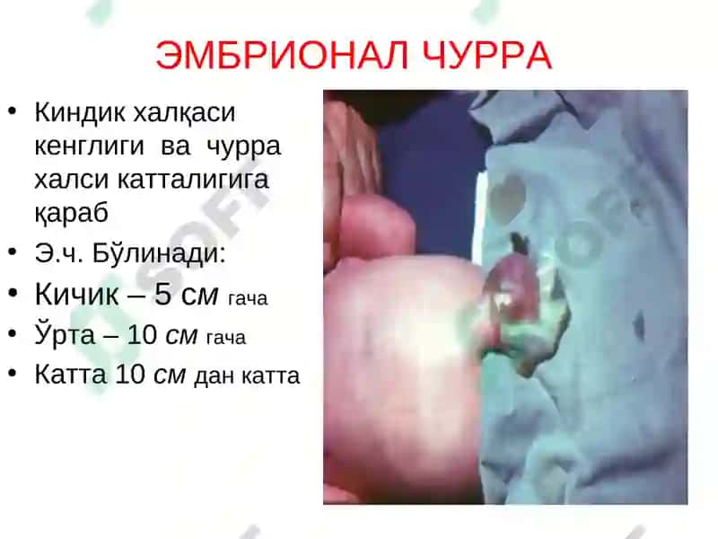 Қорин парда кин усимтасининг тугма ривожланиш нуксонлари ва аномалиялар ва чурралар 5