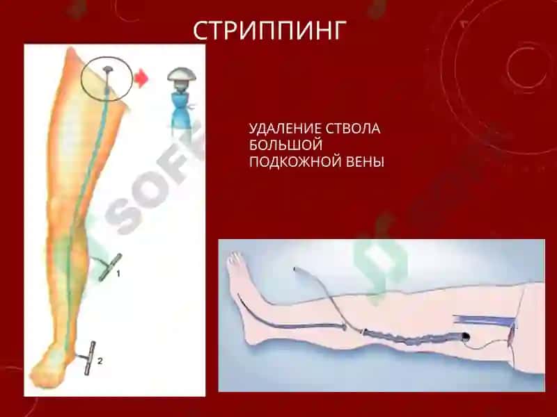 СОВРЕМЕННЫЕ МЕТОДЫ ХИРУРГИЧЕСКОГО ЛЕЧЕНИЯ ВАРИКОЗНОЙ БОЛЕЗНИ НИЖНИХ КОНЕЧНОСТЕЙ 5