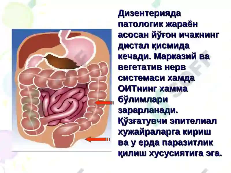 DIZENTERIYA (Ichburug‘) 6