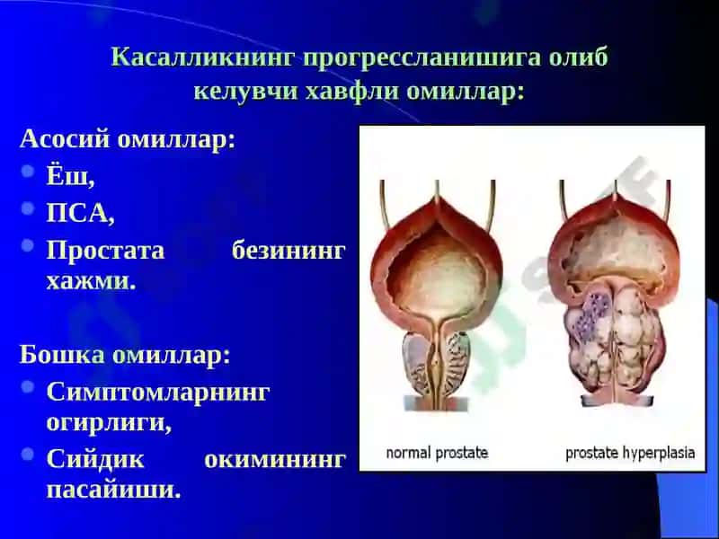 Простата бези хавфсиз гиперплазияси 6
