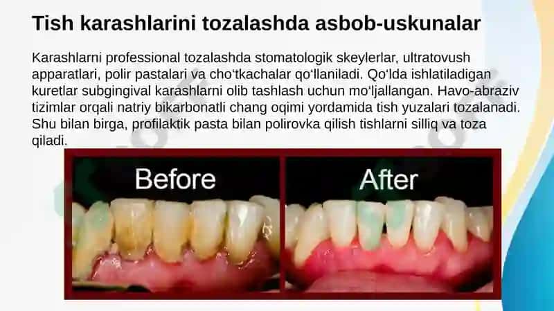 Tish karashlari. Tish karashlarini tozalash usullari, asbob-uskunalar. Parodont to’qimasini patologiyasi bor bemorlarni tekshirish usullari (asosiy va qo’shimcha usullar). Parodont to’qimasini tuzilishi, funksiyasi. Parodont kasalliklarini tasnifi 6