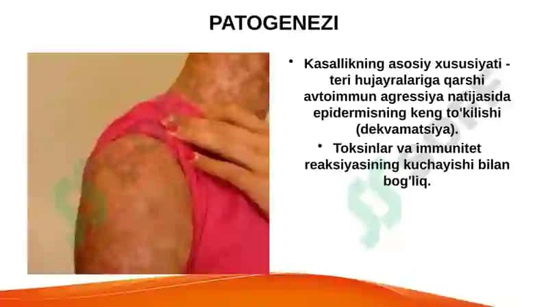 LAYELL(TEN) VA STIVENS JONSN SINDROMLARI 6