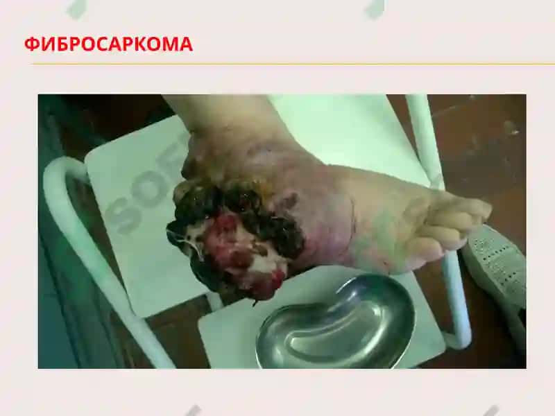 Опухоли 6