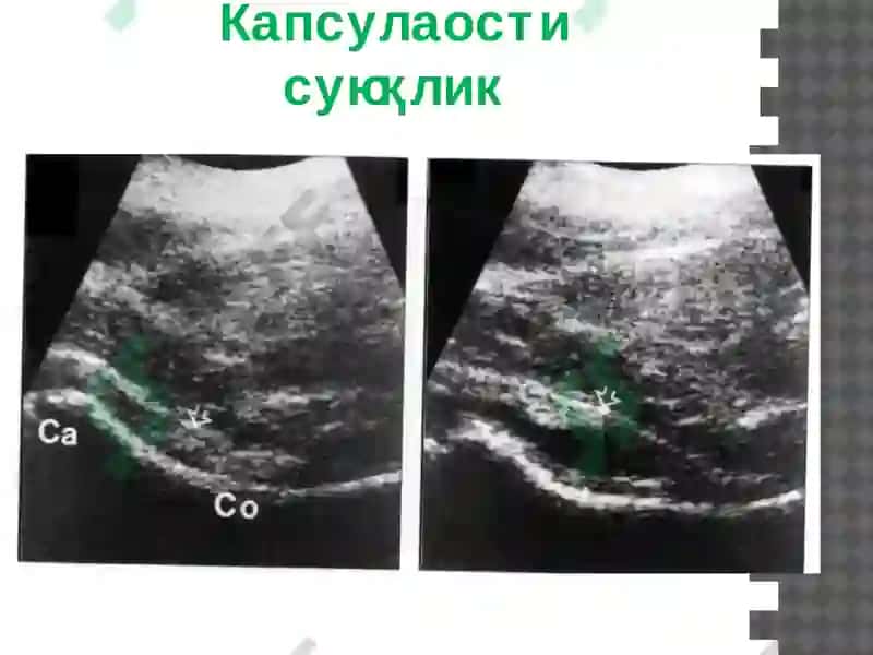 Суяк - бўғим тизими касалликларининг комплекс нур диагностикаси 6