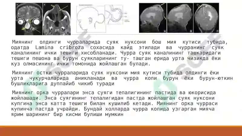Bosh miya va orqa miyaning tug’ma rivojlanish nuqsonlari 6