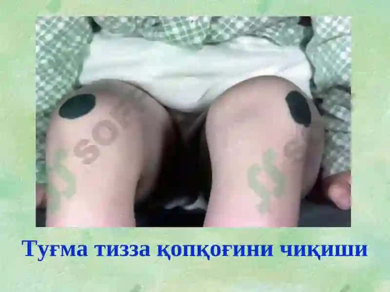 Туғма оёқ-қўл нуқсонлари 6