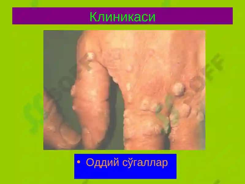 Терининг вирусли касалликлари 6